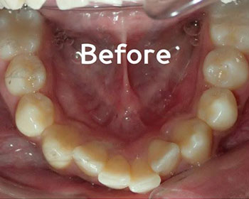 Inman Aligners Treatment Before