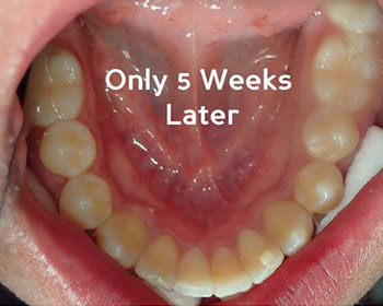 Inman Aligners Treatment After