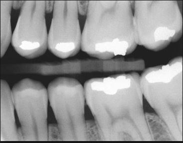 early cavity xray