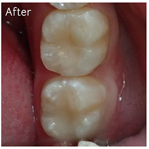 White Fillings After