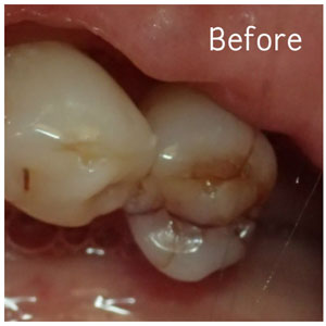 Tooth Colored Fillings Before