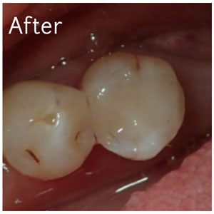 Tooth Colored Fillings After