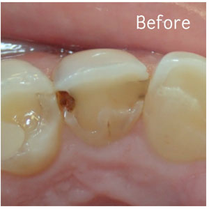 Resin Fillings Before