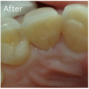 Resin Fillings After