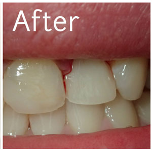 Dental Filling After