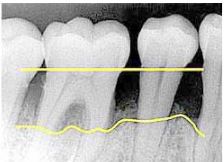 Gum Disease X-ray