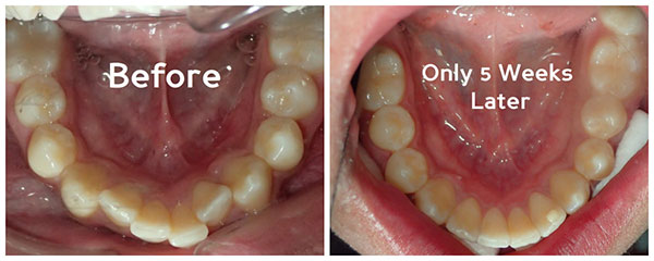 Inman Aligners Results