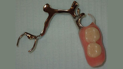 Metal-Based Partial Dentures