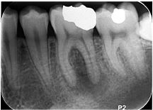 PA X-ray