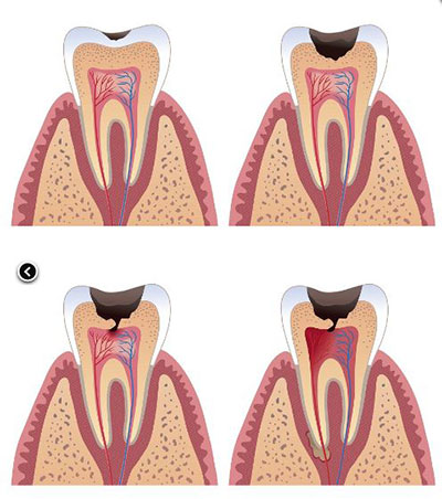 Periodontal Disease