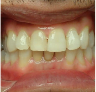 Teeth Bleaching After