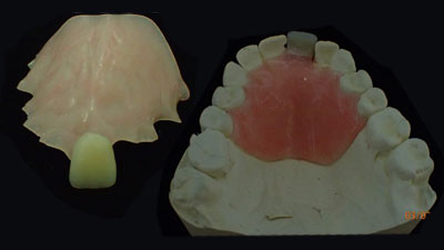 Temporary Partial Dentures