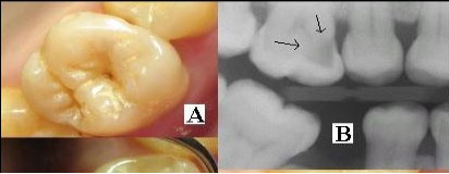 Comparison of Naked Eye and X-ray View